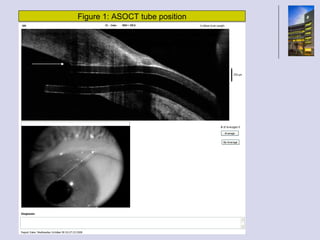 Figure 1: ASOCT tube position A 