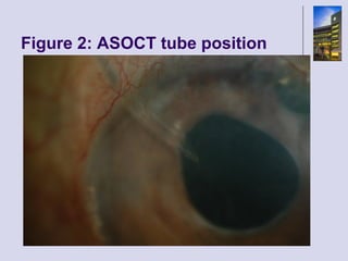 Figure 2: ASOCT tube position 