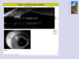 Figure 3: ASOCT tube position * 
