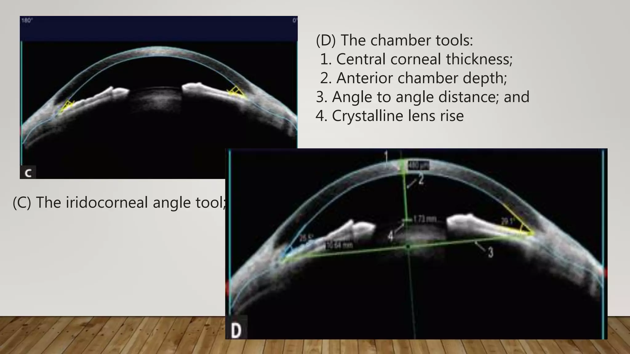 (C) The iridocorneal angle tool;
(D) The chamber tools:
1. Central corneal thickness;
2. Anterior chamber depth;
3. Angle to angle distance; and
4. Crystalline lens rise
 