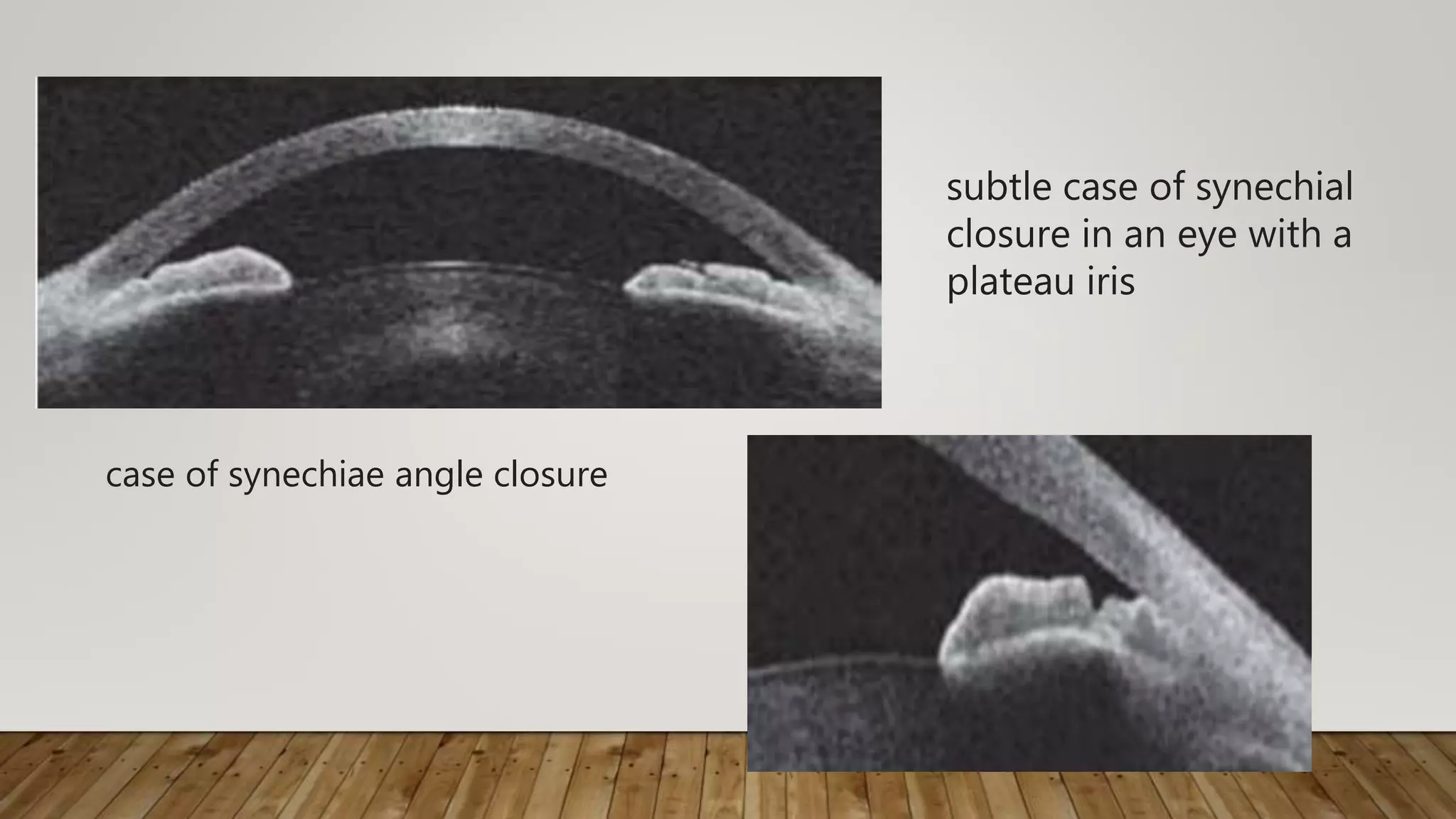 case of synechiae angle closure
subtle case of synechial
closure in an eye with a
plateau iris
 