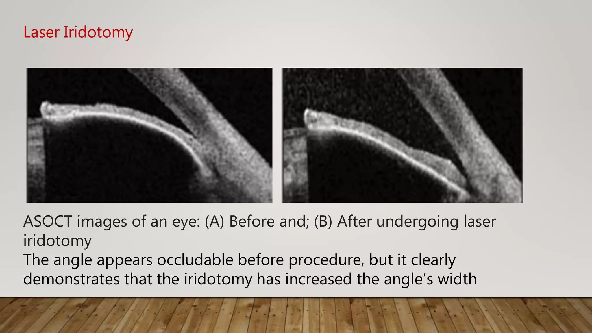 Laser Iridotomy
ASOCT images of an eye: (A) Before and; (B) After undergoing laser
iridotomy
The angle appears occludable before procedure, but it clearly
demonstrates that the iridotomy has increased the angle’s width
 