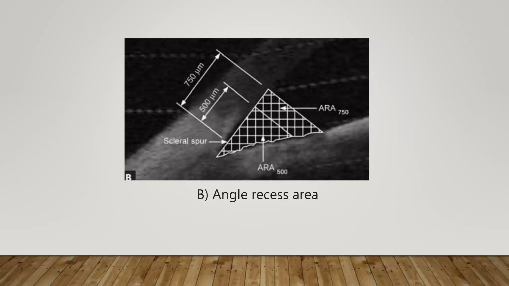 B) Angle recess area
 