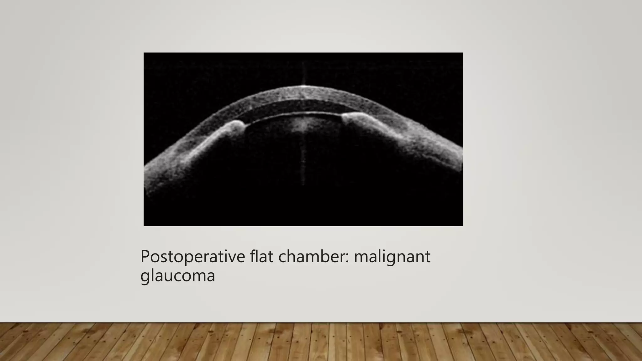 Postoperative ﬂat chamber: malignant
glaucoma
 