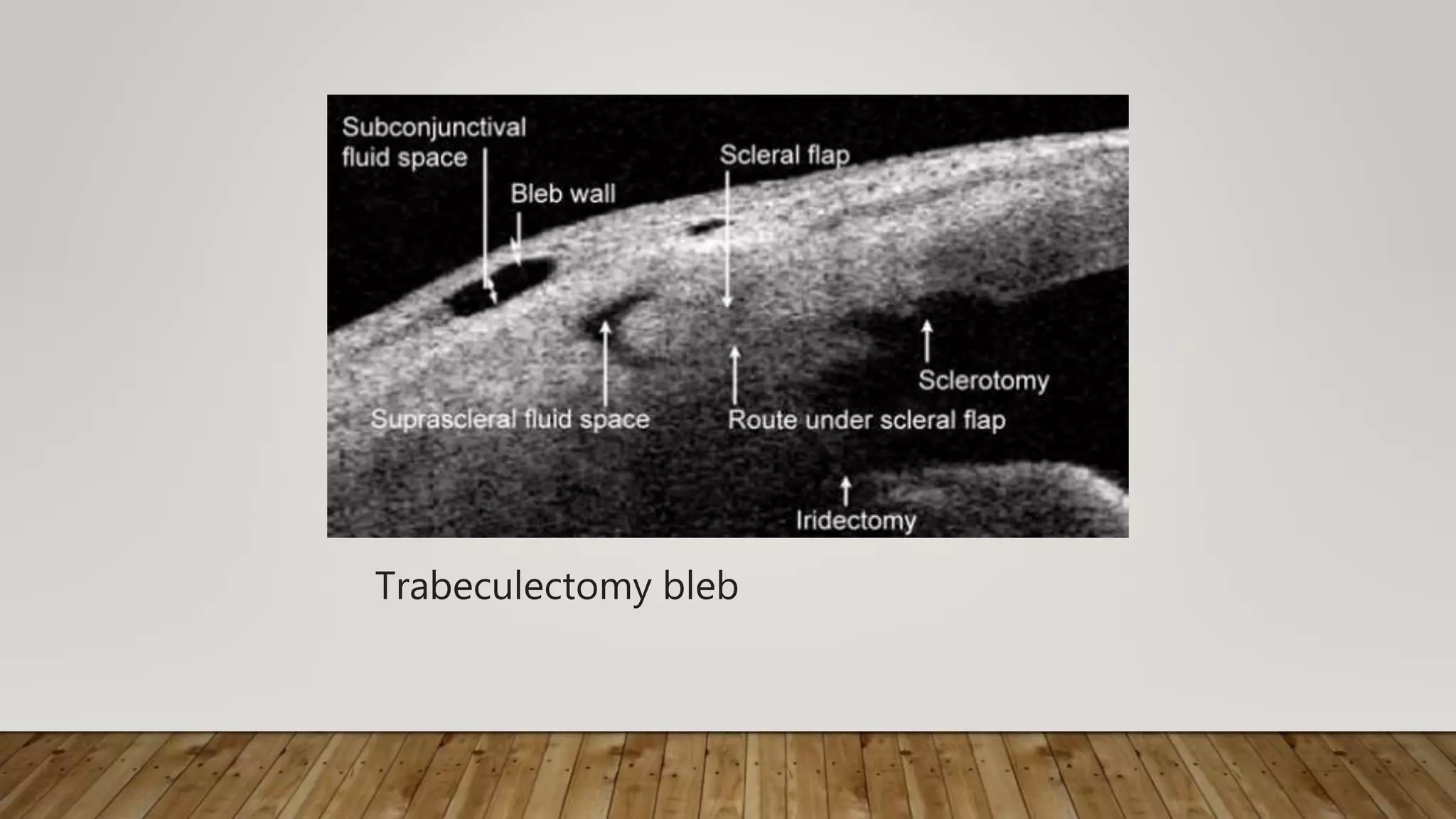 Trabeculectomy bleb
 