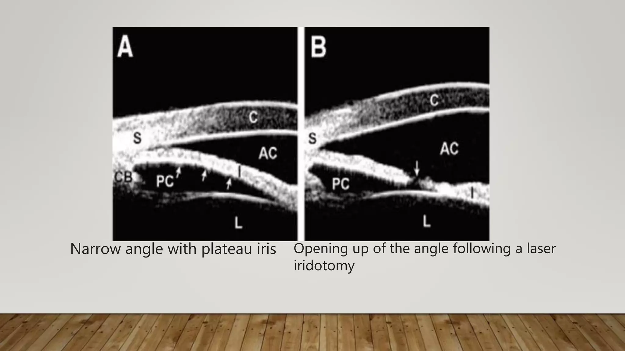 Narrow angle with plateau iris Opening up of the angle following a laser
iridotomy
 