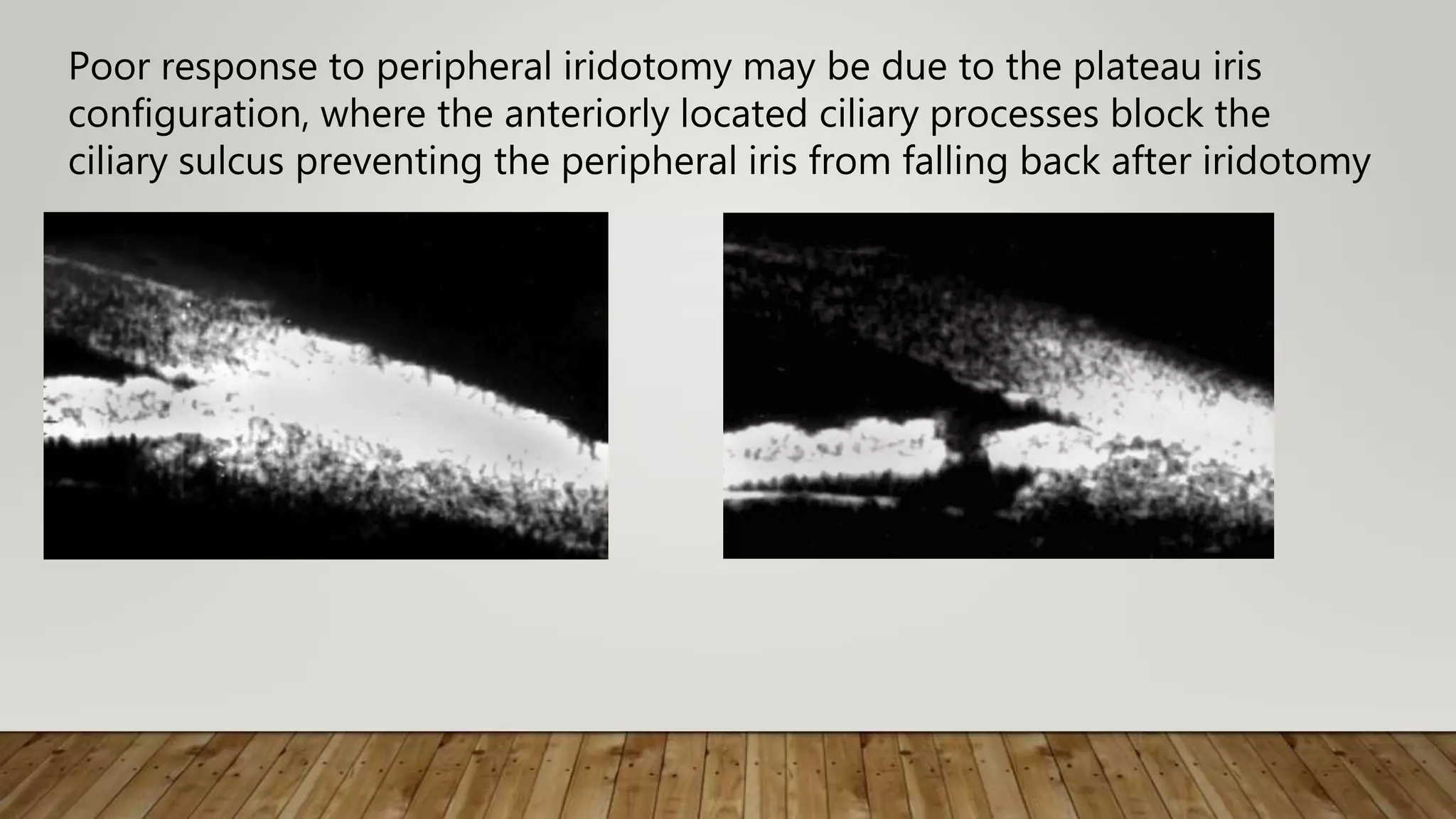 Poor response to peripheral iridotomy may be due to the plateau iris
configuration, where the anteriorly located ciliary processes block the
ciliary sulcus preventing the peripheral iris from falling back after iridotomy
 