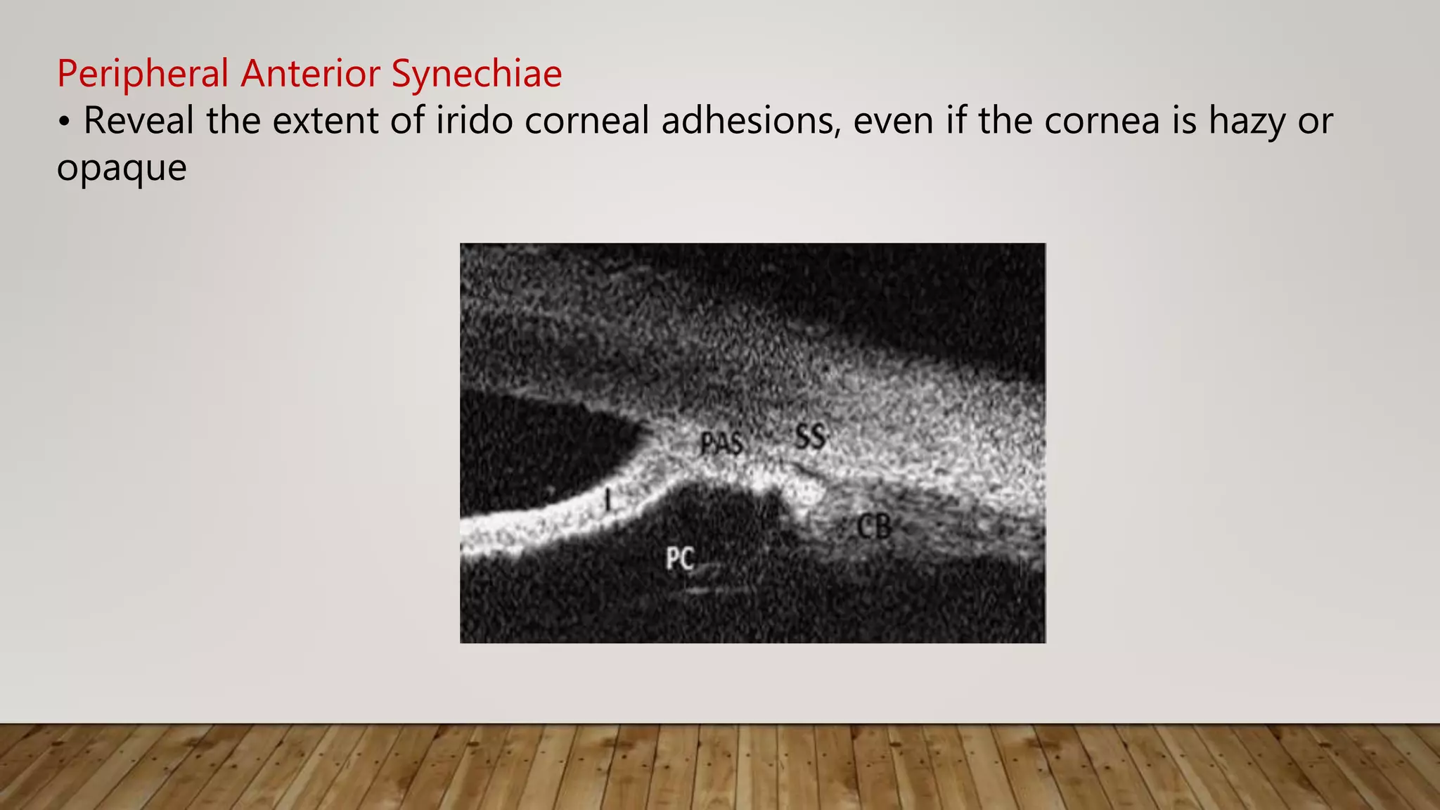 Peripheral Anterior Synechiae
• Reveal the extent of irido corneal adhesions, even if the cornea is hazy or
opaque
 