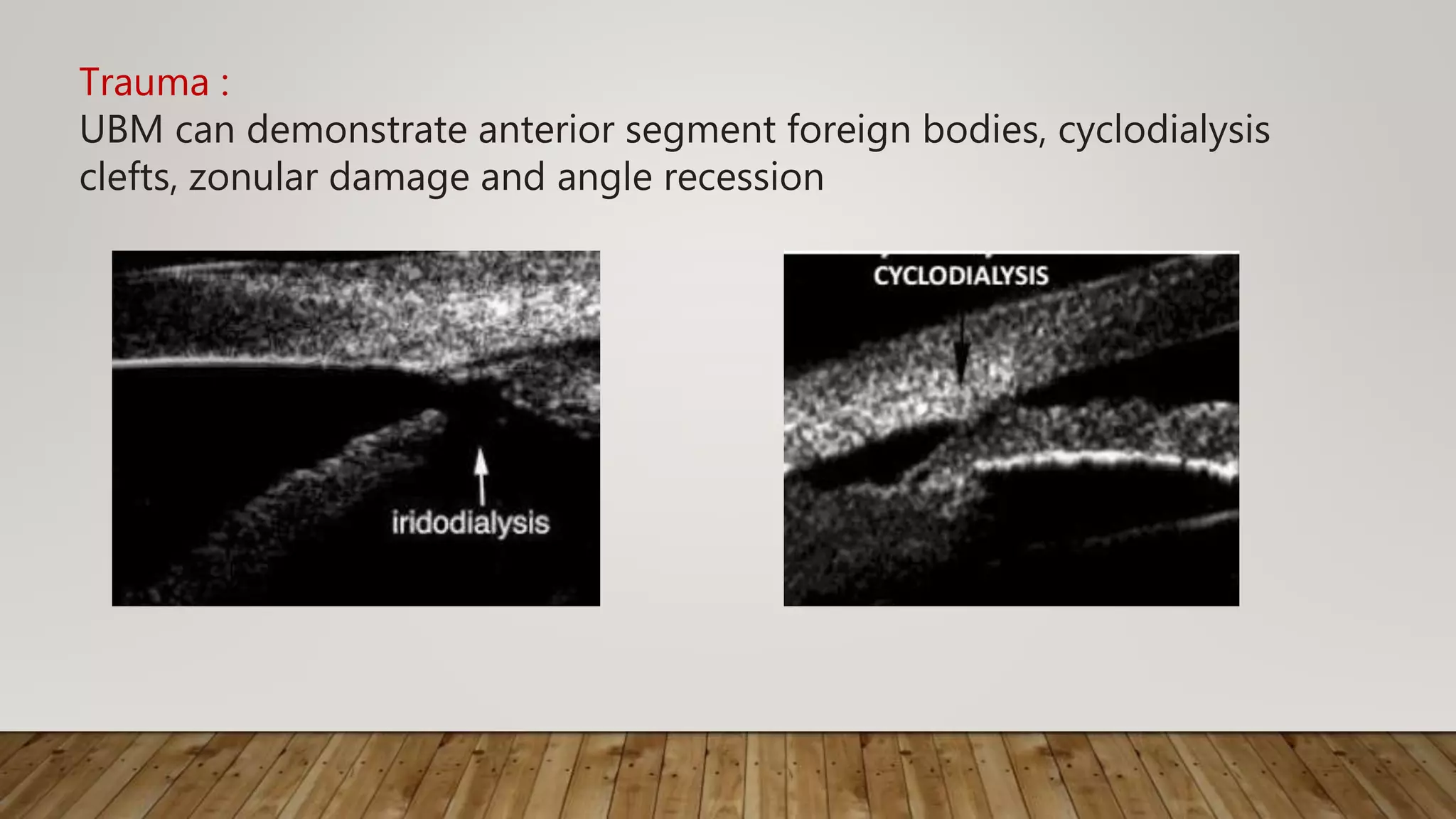 Trauma :
UBM can demonstrate anterior segment foreign bodies, cyclodialysis
clefts, zonular damage and angle recession
 