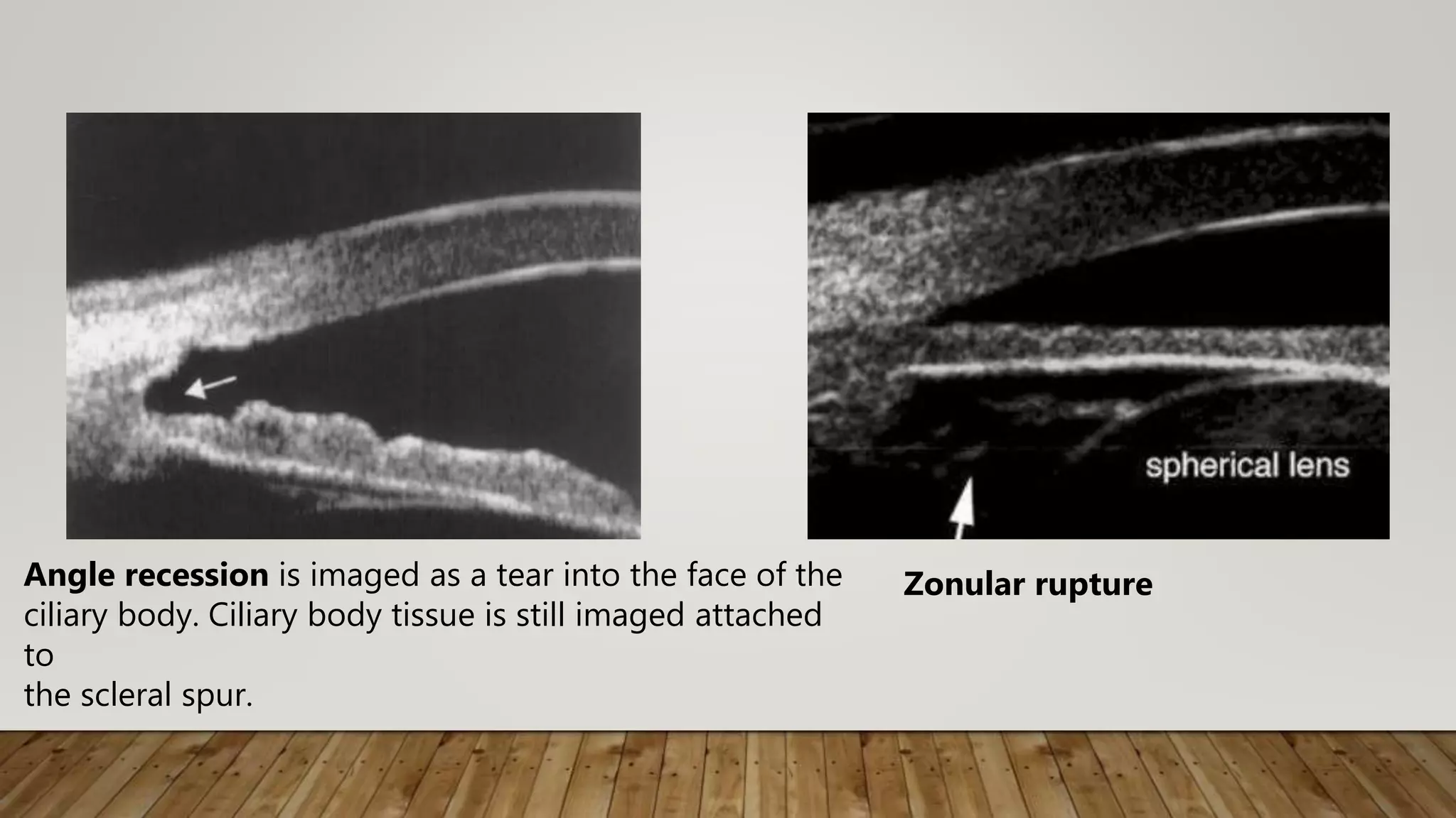 Angle recession is imaged as a tear into the face of the
ciliary body. Ciliary body tissue is still imaged attached
to
the scleral spur.
Zonular rupture
 