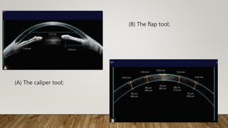 (A) The caliper tool;
(B) The flap tool;
 