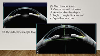 (C) The iridocorneal angle tool;
(D) The chamber tools:
1. Central corneal thickness;
2. Anterior chamber depth;
3. Angle to angle distance; and
4. Crystalline lens rise
 