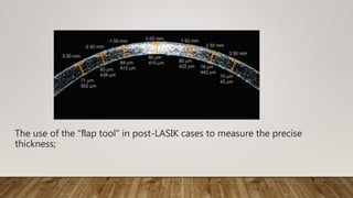 The use of the “ﬂap tool” in post-LASIK cases to measure the precise
thickness;
 