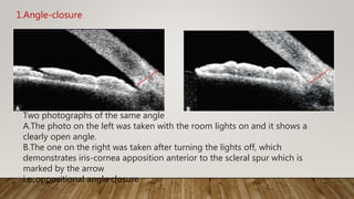 Two photographs of the same angle
A.The photo on the left was taken with the room lights on and it shows a
clearly open angle.
B.The one on the right was taken after turning the lights off, which
demonstrates iris-cornea apposition anterior to the scleral spur which is
marked by the arrow
i.e.,oppositional angle closure
1.Angle-closure
 