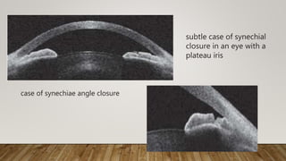 case of synechiae angle closure
subtle case of synechial
closure in an eye with a
plateau iris
 