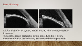 Laser Iridotomy
ASOCT images of an eye: (A) Before and; (B) After undergoing laser
iridotomy
The angle appears occludable before procedure, but it clearly
demonstrates that the iridotomy has increased the angle’s width
 