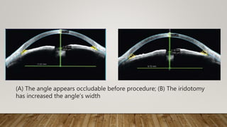 (A) The angle appears occludable before procedure; (B) The iridotomy
has increased the angle’s width
 