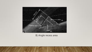 B) Angle recess area
 