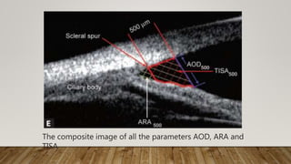 The composite image of all the parameters AOD, ARA and
TISA
 