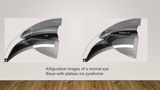 A)figurative images of a normal eye
B)eye with plateau iris syndrome
 