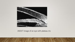 ASOCT image of an eye with plateau iris
 