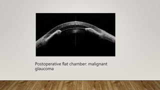 Postoperative ﬂat chamber: malignant
glaucoma
 