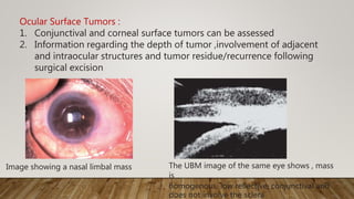 Ocular Surface Tumors :
1. Conjunctival and corneal surface tumors can be assessed
2. Information regarding the depth of tumor ,involvement of adjacent
and intraocular structures and tumor residue/recurrence following
surgical excision
The UBM image of the same eye shows , mass
is
homogenous, low reﬂective, conjunctival and
does not involve the sclera
Image showing a nasal limbal mass
 
