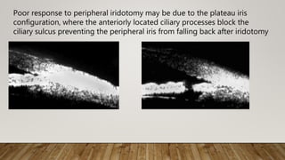 Poor response to peripheral iridotomy may be due to the plateau iris
configuration, where the anteriorly located ciliary processes block the
ciliary sulcus preventing the peripheral iris from falling back after iridotomy
 