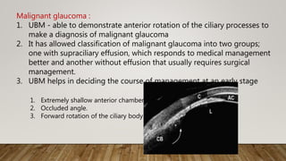 Malignant glaucoma :
1. UBM - able to demonstrate anterior rotation of the ciliary processes to
make a diagnosis of malignant glaucoma
2. It has allowed classification of malignant glaucoma into two groups;
one with supraciliary effusion, which responds to medical management
better and another without effusion that usually requires surgical
management.
3. UBM helps in deciding the course of management at an early stage
1. Extremely shallow anterior chamber.
2. Occluded angle.
3. Forward rotation of the ciliary body.
 