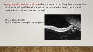 In pigment dispersion syndrome there is reverse pupillary block where the
posterior bowing of the iris causes an increase in iris-lens contact and
sometimes iris zonular contact as well.
Widely opened angle
Typical Posterior bowing of the peripheral iris
 