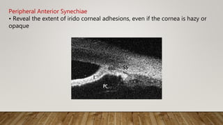 Peripheral Anterior Synechiae
• Reveal the extent of irido corneal adhesions, even if the cornea is hazy or
opaque
 