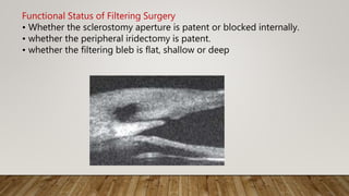 Functional Status of Filtering Surgery
• Whether the sclerostomy aperture is patent or blocked internally.
• whether the peripheral iridectomy is patent.
• whether the filtering bleb is flat, shallow or deep
 