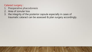 Cataract surgery :
1. Preoperative phacodonesis
2. Area of zonular loss
3. the integrity of the posterior capsule especially in cases of
traumatic cataract can be assessed & plan surgery accordingly.
 