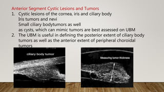 Anterior Segment Cystic Lesions and Tumors
1. Cystic lesions of the cornea, iris and ciliary body
Iris tumors and nevi
Small ciliary bodytumors as well
as cysts, which can mimic tumors are best assessed on UBM
2. The UBM is useful in defining the posterior extent of ciliary body
tumors as well as the anterior extent of peripheral choroidal
tumors
 
