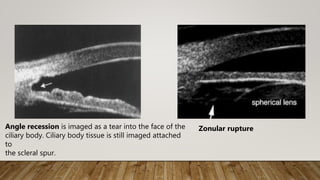 Angle recession is imaged as a tear into the face of the
ciliary body. Ciliary body tissue is still imaged attached
to
the scleral spur.
Zonular rupture
 
