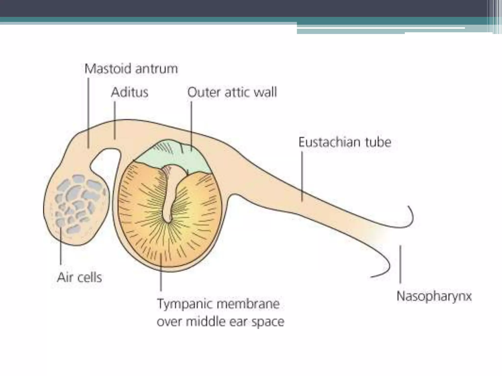 acute suppurative otitis media | PPTX