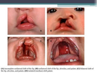 (A) incomplete unilateral cleft of the lip, (B) unilateral cleft of the lip, alveolus, and palate, (C) bilateral cleft of 
the lip, alveolus, and palate, (D) isolated (median) cleft palate. 
 