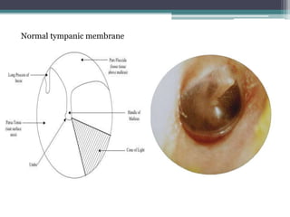 Normal tympanic membrane 
 