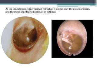As the drum becomes increasingly retracted, it drapes over the ossicular chain, 
and the incus and stapes head may be outlined. 
 