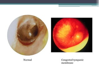 Normal Congested tympanic 
membrane 
 
