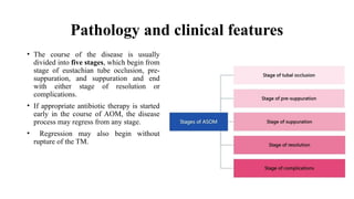 ASOM.pptx acute suppurative otitis media | PPTX