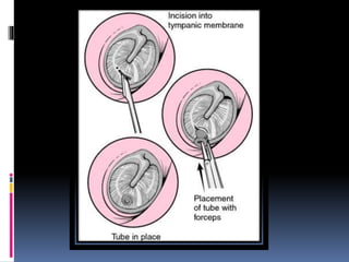 ASOM & Mastoiditis | PPTX