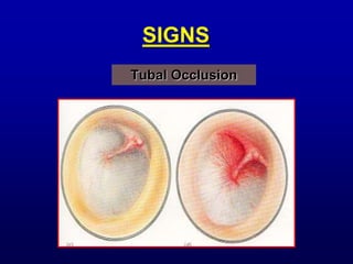 ACUTE SUPPURATIVE OTITIS MEDIA FOR UNDERGRADUATES | PPT