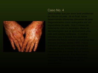 Caso No. 4  Uma mulher que por anos teve problemas de câncer de pele. Já no final, havia desenvolvido diferentes cânceres de pele diagnosticados como avançados por um especialista de pele.  Aos 3 meses de tratamento com os aspargos, disse ao dermatologista que já apresentava uma pele sem lesões cutâneas.  A mulher informou que a terapia dos aspargos também lhe havia curado uma doença dos rins que possuia  desde 1949.  Havia sofrido10 operações para retirada de cálculos renais, e recebia do governo, indenizações por causa de seu estado inoperável, terminal.  Ela reconhecia inteiramente que a cura se devia aos aspargos.. Este resultado não me surpreendeu! 