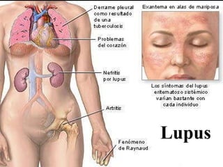 Lupus 