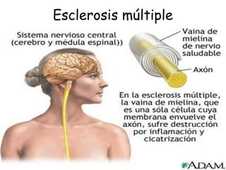 Esclerosis múltiple
 