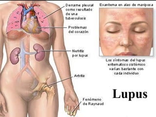 Lupus
 
