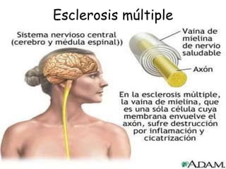 Esclerosis múltiple 