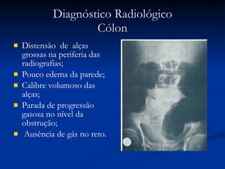 Diagnóstico Radiológico Cólon Distensão  de  alças grossas na periferia das radiografias;  Pouco edema da parede; Calibre volumoso das alças;  Parada de progressão gasosa no nível da obstrução; Ausência de gás no reto. 