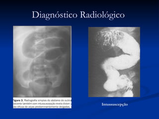 Diagnóstico Radiológico  Intussuscepção 